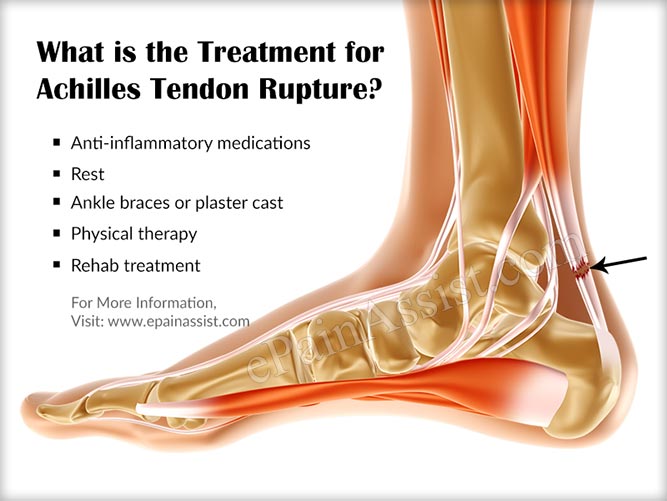Rupture Of Achilles Tendon Rupture Tendon D Achille Sans Op ration BSBF